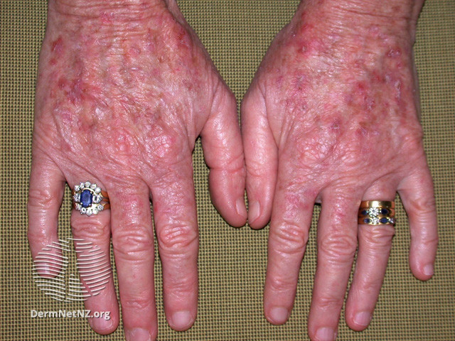 Actinic Keratoses treated with imiquimod (DermNet NZ lesions-ak-imiquimod-3745).jpg