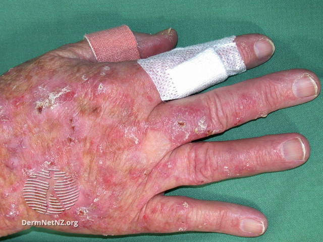 File:Actinic keratoses affecting the hands (DermNet NZ lesions-ak-hands-496).jpg