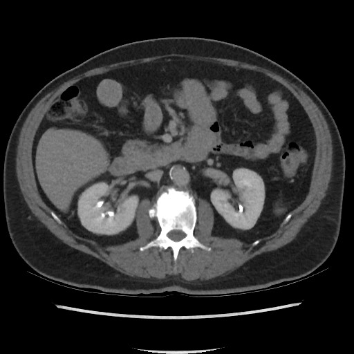 File:Active colonic bleed on CT (Radiopaedia 49765-55025 Axial C+ delayed 34).jpg