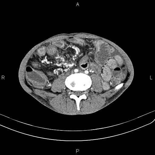 Active crohn disease (Radiopaedia 87133-103397 Axial C+ arterial phase 62).jpg