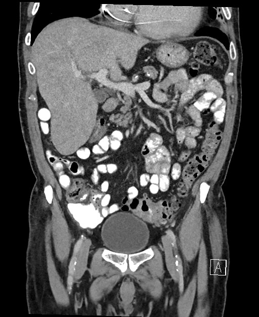Active lower gastrointestinal bleeding - diverticular (Radiopaedia 61203-69106 Coronal C+ portal venous phase 54).jpg