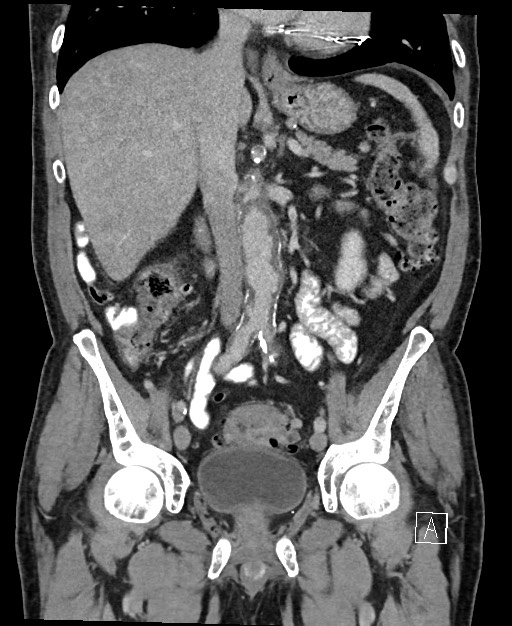 Active lower gastrointestinal bleeding - diverticular (Radiopaedia 61203-69106 Coronal C+ portal venous phase 70).jpg