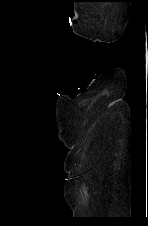Active renal extravasation with large subcapsular and retroperitoneal hemorrhage (Radiopaedia 60975-68796 Sagittal C+ portal venous phase 25).jpg