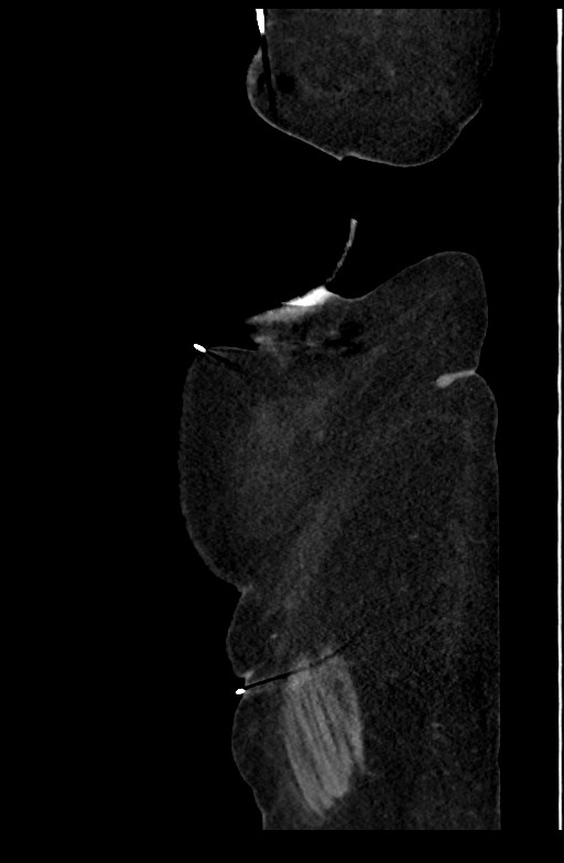 Active renal extravasation with large subcapsular and retroperitoneal hemorrhage (Radiopaedia 60975-68796 Sagittal C+ portal venous phase 29).jpg