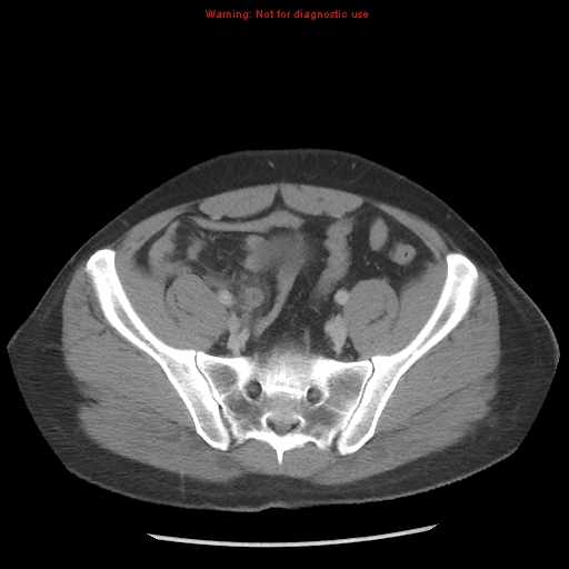 Acute appendicitis (Radiopaedia 10498-10973 Axial C+ portal venous phase 35).jpg