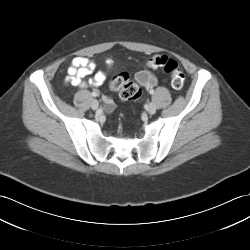 Acute appendicitis (Radiopaedia 30297-30934 Axial C+ portal venous phase 63).jpg