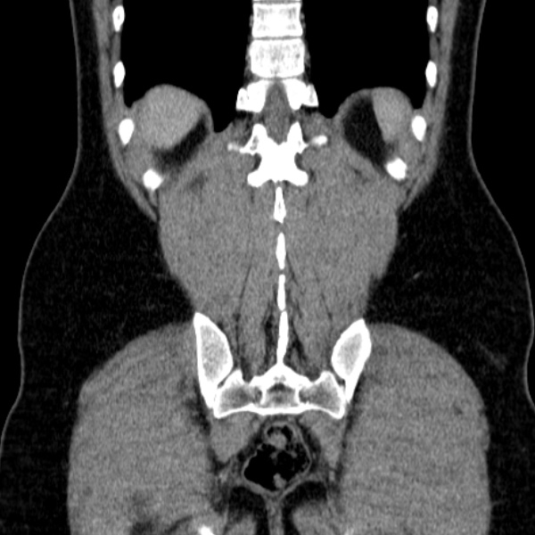 Acute appendicitis (Radiopaedia 38255-40270 Coronal C+ portal venous phase 72).jpg