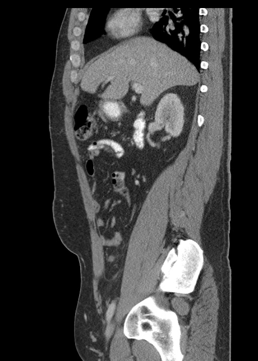 Acute appendicitis (Radiopaedia 48511-53463 Sagittal C+ portal venous phase 54).jpg