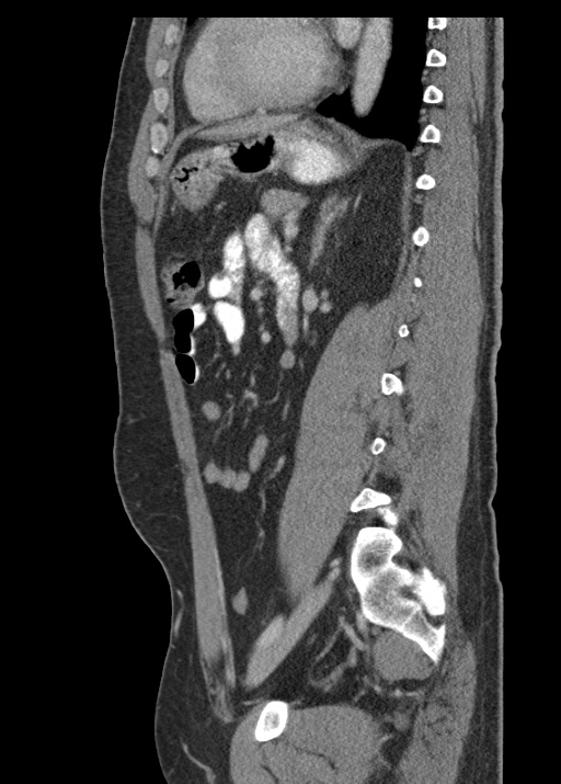 Acute appendicitis (Radiopaedia 48511-53463 Sagittal C+ portal venous phase 84).jpg