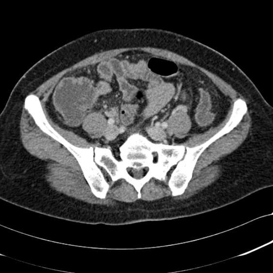 Acute appendicitis (Radiopaedia 48792-53822 Axial C+ portal venous phase 83).jpg
