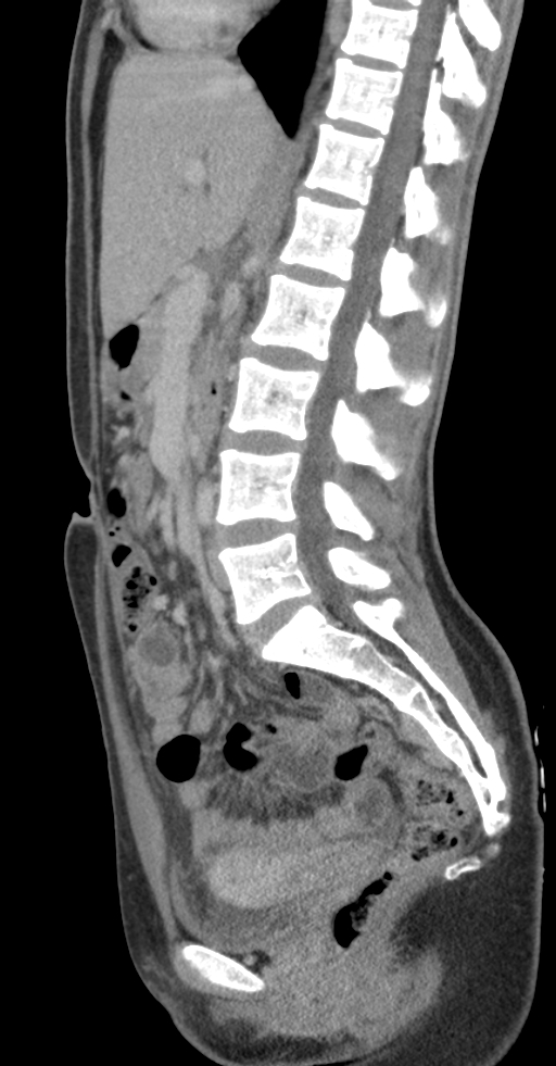 Acute appendicitis (Radiopaedia 62608-70901 Sagittal C+ portal venous phase 18).jpg