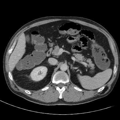 Acute appendicitis (Radiopaedia 66513-75790 Axial C+ portal venous phase 17).jpg
