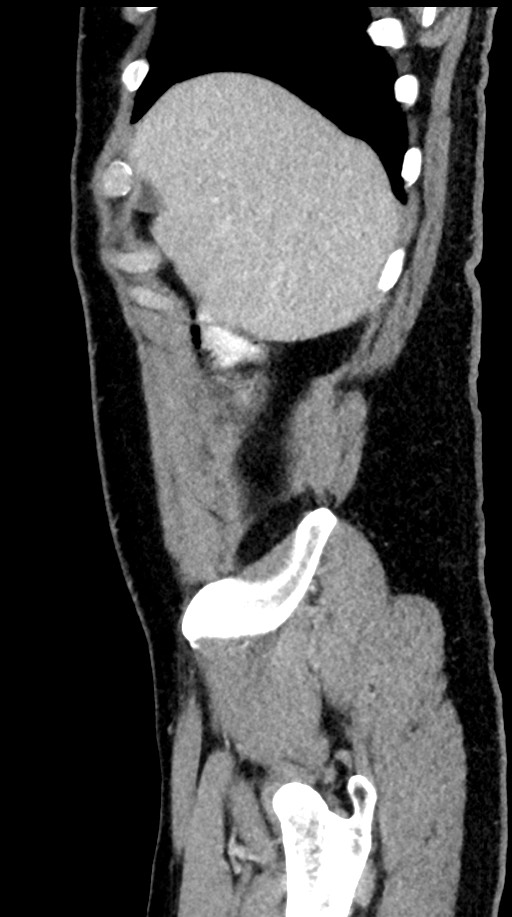 Acute appendicitis (Radiopaedia 77016-88960 Sagittal C+ portal venous phase 98).jpg