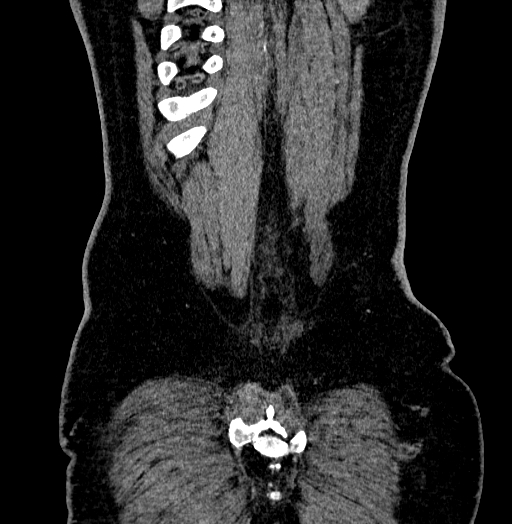 Acute appendicitis (Radiopaedia 79950-93224 Coronal C+ portal venous phase 90).jpg