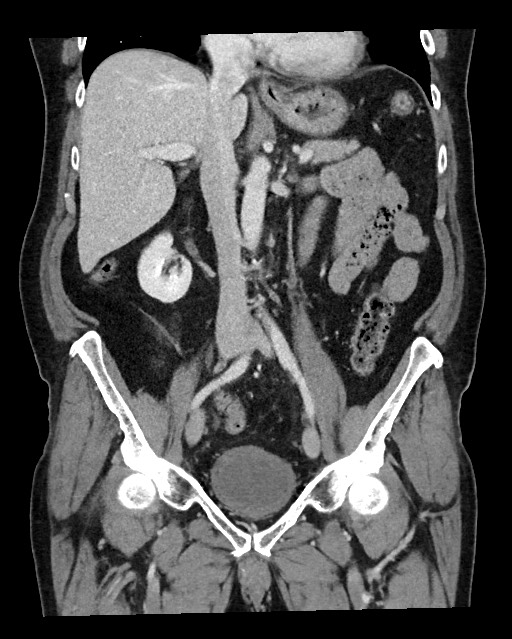 Acute appendicitis - large appendicoliths (Radiopaedia 61805-69820 Coronal C+ portal venous phase 68).jpg