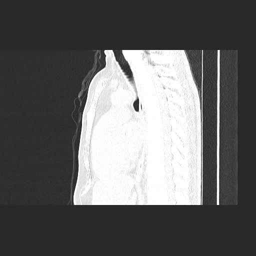 File:Acute appendicitis and COVID 19 pneumonia (Radiopaedia 76604-88380 Sagittal lung window 50).jpg