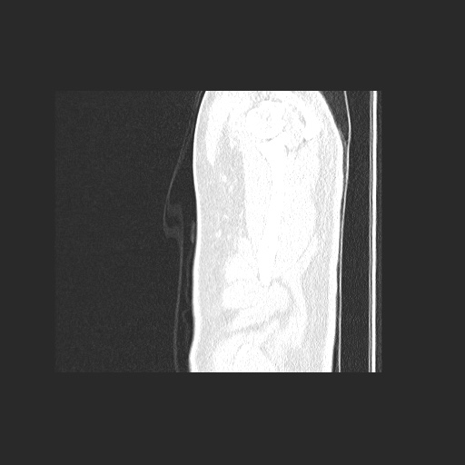 Acute appendicitis and COVID 19 pneumonia (Radiopaedia 76604-88380 Sagittal lung window 96).jpg