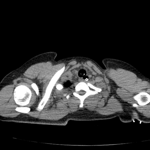 Acute aspiration pneumonitis (Radiopaedia 33605-34703 Axial non-contrast 17).jpg