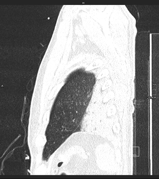 Acute aspiration pneumonitis (Radiopaedia 55642-62166 Sagittal lung window 9).jpg