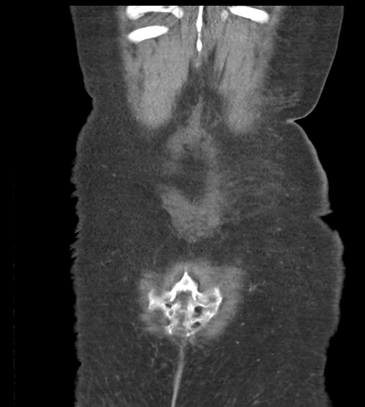 Acute bleed from gastric fundus biopsy site (Radiopaedia 35201-36737 D 53).png
