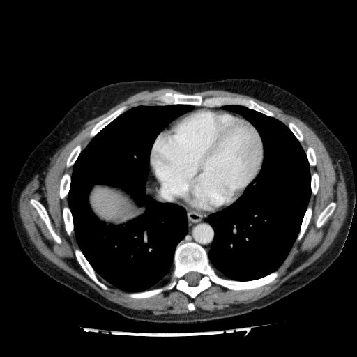 File:Acute cholecystitis and incidental left sided IVC (Radiopaedia 49352-54459 Axial C+ portal venous phase 17).jpg