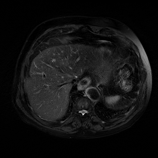 File:Acute cholecystitis complicated by pylephlebitis (Radiopaedia 65782-74915 Axial T2 fat sat 9).jpg