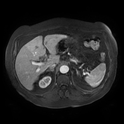 Acute cholecystitis complicated by pylephlebitis (Radiopaedia 65782-74915 Axial arterioportal phase T1 C+ fat sat 46).jpg
