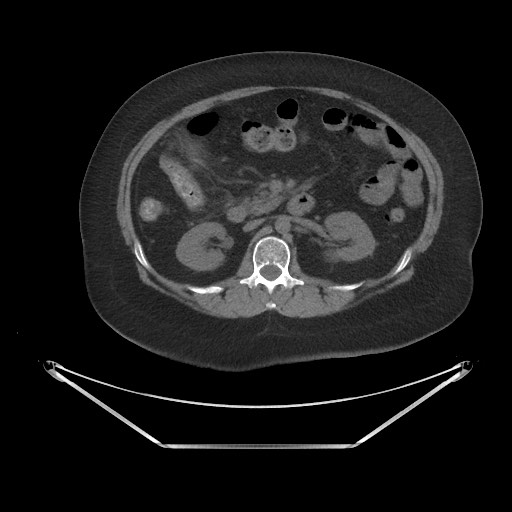 Acute cholecystitis with tensile fundus sign (Radiopaedia 71394-81723 Axial non-contrast 33).jpg