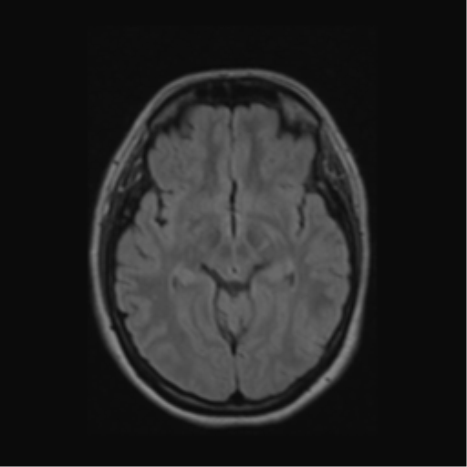 Acute disseminated encephalomyelitis (ADEM) (Radiopaedia 38073-40065 Axial FLAIR 27).png