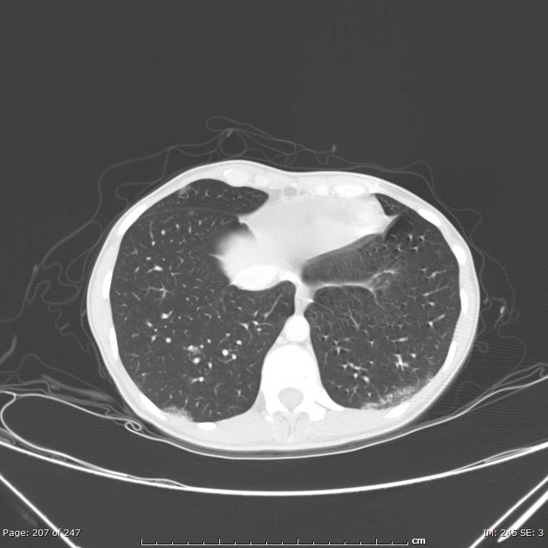 Acute eosinophilic pneumonia (Radiopaedia 48211-53073 Axial lung window 74).jpg
