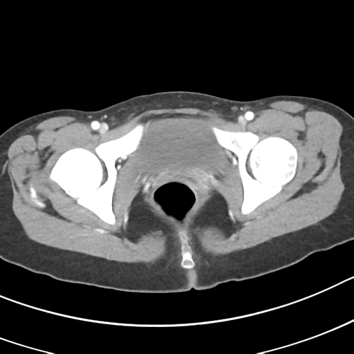 Acute gangrenous appendicitis with perforation (Radiopaedia 40152-42662 Axial C+ portal venous phase 73).png