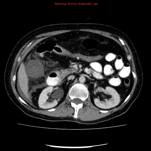 Acute gangrenous cholecystitis (Radiopaedia 10123-10661 Axial C+ portal venous phase 39).jpg