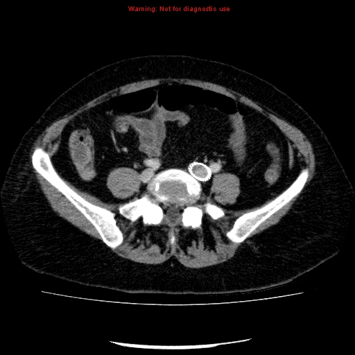 Acute gangrenous cholecystitis (Radiopaedia 10123-10661 Axial C+ portal venous phase 72).jpg