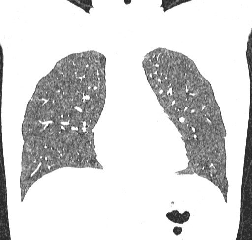 Acute hypersensitivity pneumonitis (Radiopaedia 85293-100870 Coronal lung window 42).jpg