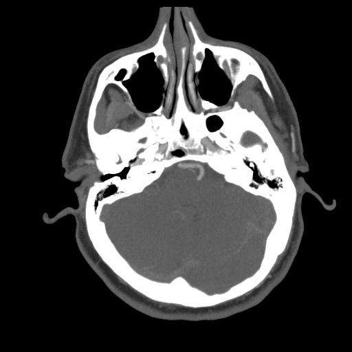 File:Acute internal carotid artery dissection (Radiopaedia 53541-59630 D 20).jpg