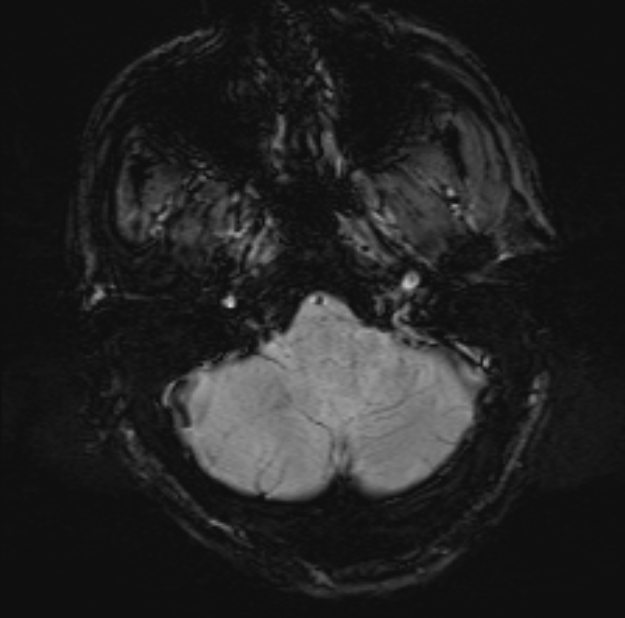 Acute ischemic stroke - posterior circulation territory (Radiopaedia 77670-89880 Axial SWI 10).jpg