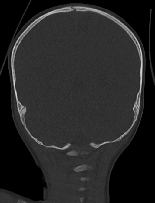 Acute mastoiditis (Radiopaedia 82678-96881 Coronal bone window 58).jpg