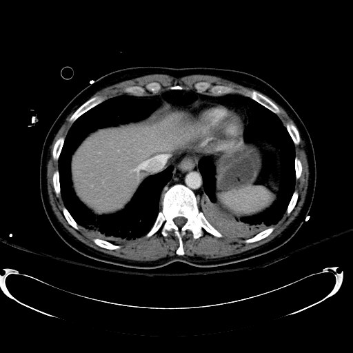 File:Acute myocardial infarction in CT (Radiopaedia 39947-42415 Axial C+ portal venous phase 17).jpg