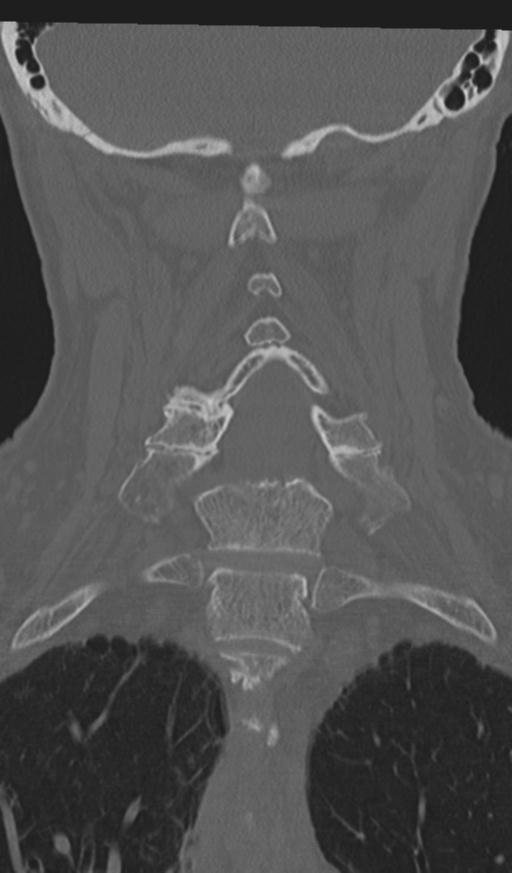 Acute on chronic subdural hematoma and thoracic vertebral injury in a multitrauma patient (Radiopaedia 31698-32619 Coronal bone window 36).jpg