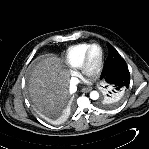 File:Acute pancreatic necrosis (Radiopaedia 13560-13486 Axial C+ portal venous phase 17).jpg