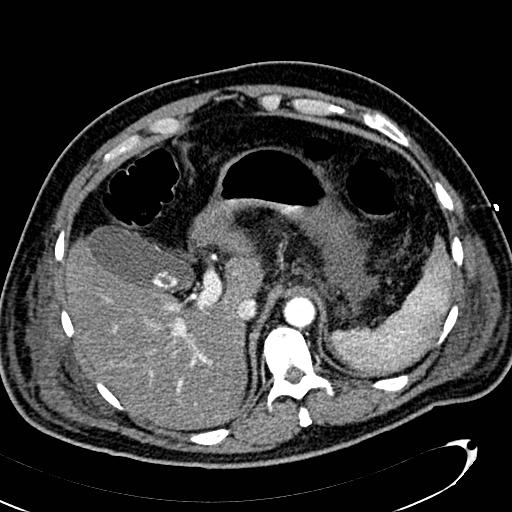 File:Acute pancreatic necrosis (Radiopaedia 13560-13486 Axial C+ portal venous phase 38).jpg