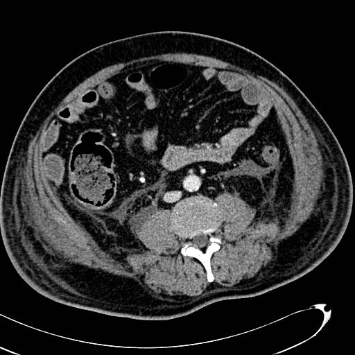 File:Acute pancreatic necrosis (Radiopaedia 13560-13486 Axial C+ portal venous phase 95).jpg