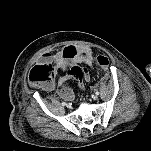 File:Acute pancreatic necrosis (Radiopaedia 13560-18501 Axial C+ portal venous phase 113).jpg