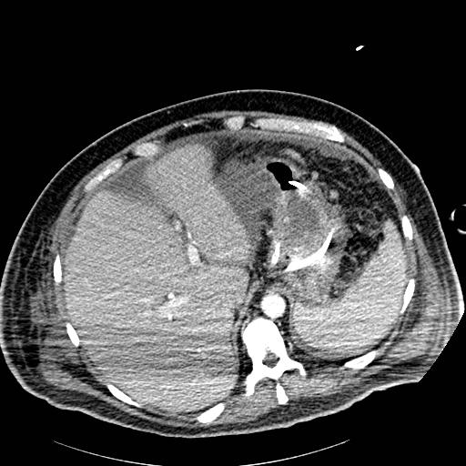 Acute pancreatic necrosis (Radiopaedia 13560-18502 Axial C+ portal venous phase 4).jpg