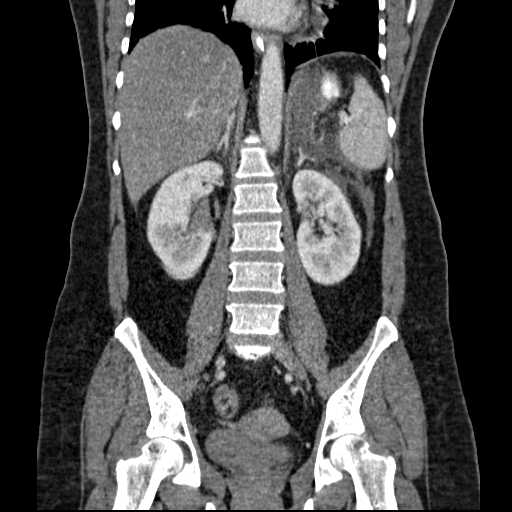 File:Acute pancreatitis (Radiopaedia 20829-20744 Coronal C+ portal venous phase 35).jpg