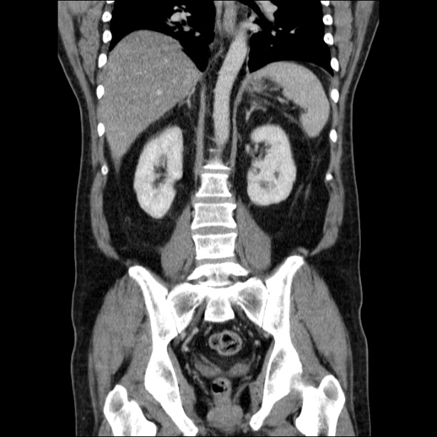 Acute pancreatitis (Radiopaedia 26663-26813 Coronal C+ portal venous phase 43).jpg