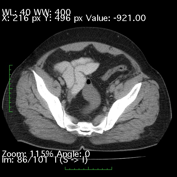Acute pancreatitis (Radiopaedia 34043-35276 Axial non-contrast 86).jpg