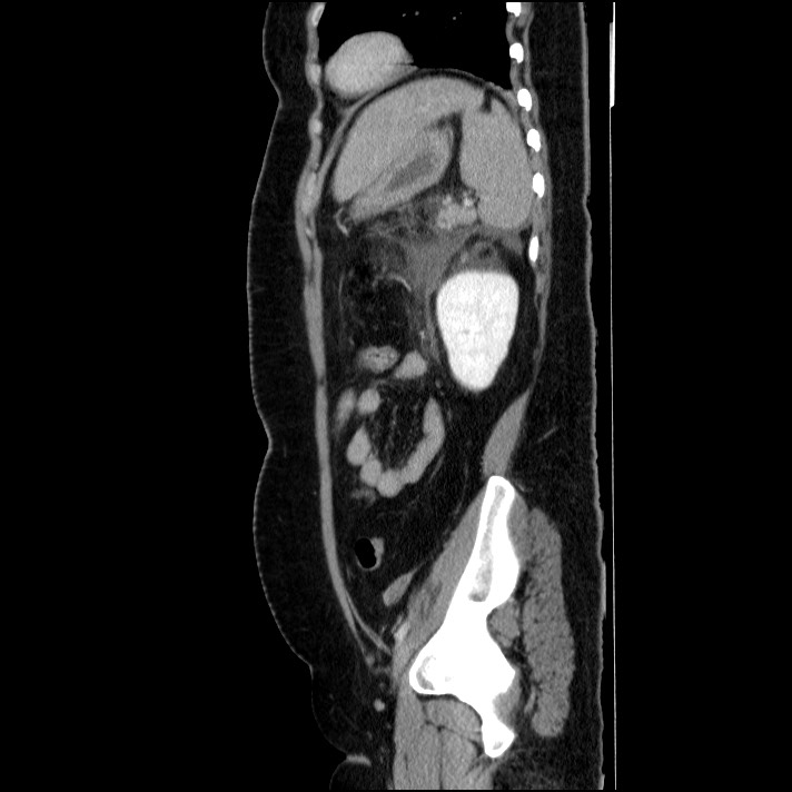 Acute pancreatitis (Radiopaedia 69236-79012 Sagittal C+ portal venous phase 33).jpg