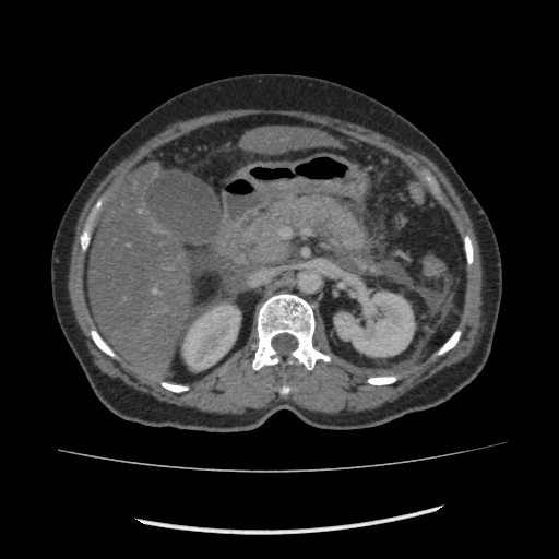 Acute pancreatitis (Radiopaedia 80007-93285 Axial C+ portal venous phase 62).jpg