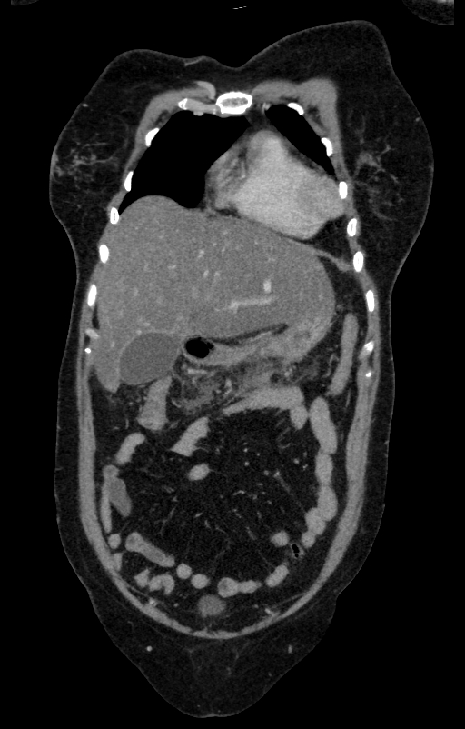 Acute pancreatitis (Radiopaedia 80007-93285 Coronal C+ portal venous phase 18).jpg